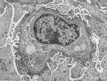 tem syndrome renal biopsy alport specimens membrane basement disease thin shown cases left right
