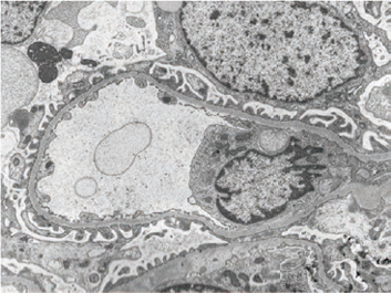 tem syndrome biopsy alport membrane specimens renal basement disease thin shown cases left right